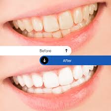 Dentist Approved Teeth Whitening Powder